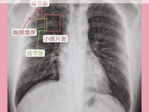 2023 年免费的胸片曝光为何-如何-怎样更新？